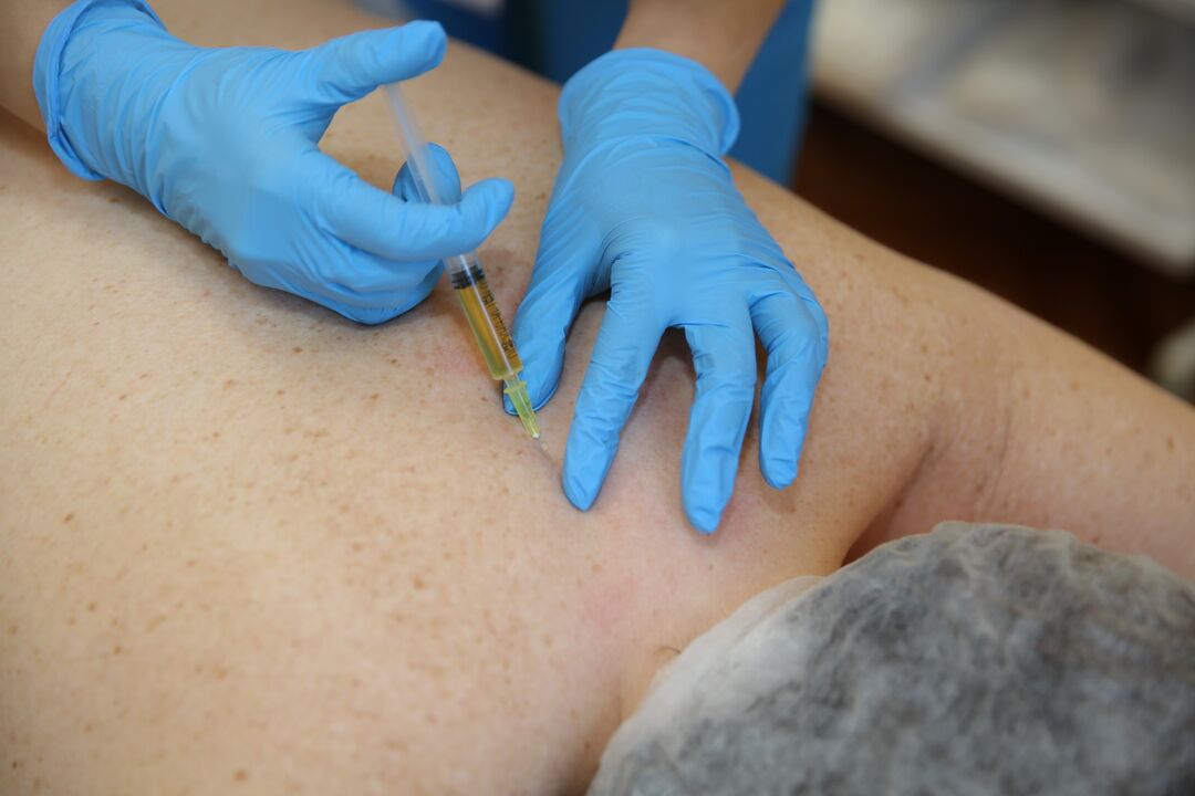 injekcije kondroprotektora za leđa