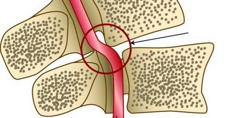 Deformacija vertebralne arterije zbog nestabilnosti kralježaka