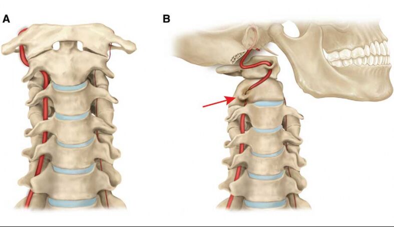 Tijek vertebralne arterije